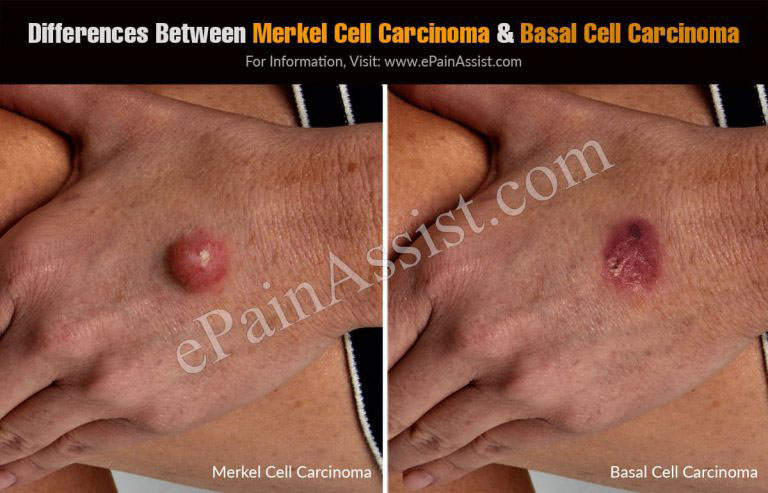 Differences Between Merkel Cell Carcinoma & Basal Cell Carcinoma