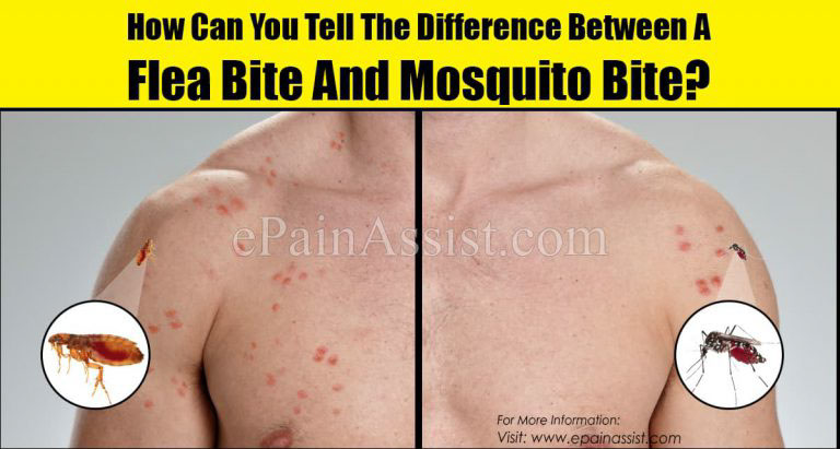 How Can You Tell The Difference Between A Flea Bite And Mosquito Bite?