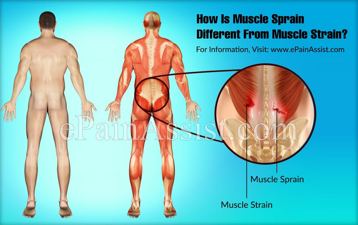 How Is Muscle Sprain Different From Muscle Strain?