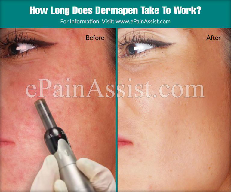 How Long Does Dermapen Take to Work & what Are The Side Effects of Dermapen?
