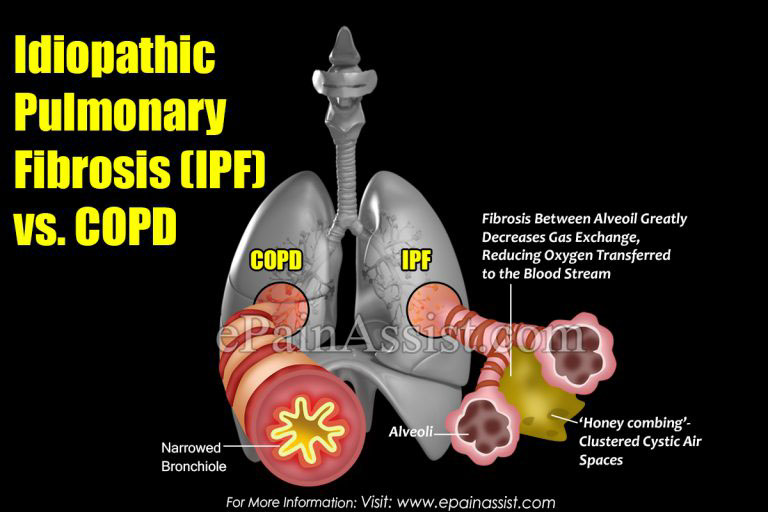Idiopathic Pulmonary Fibrosis (IPF) vs. COPD