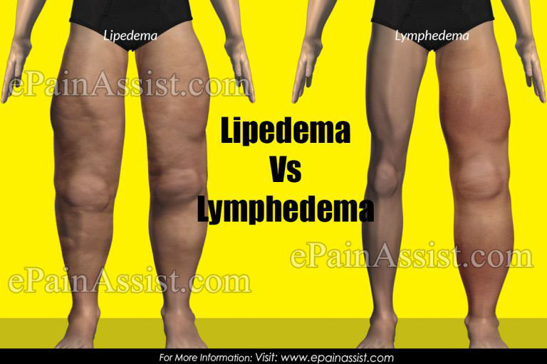 Lipedema Vs Lymphedema