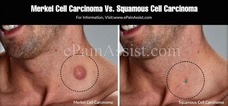 Merkel Cell Carcinoma Vs. Squamous Cell Carcinoma