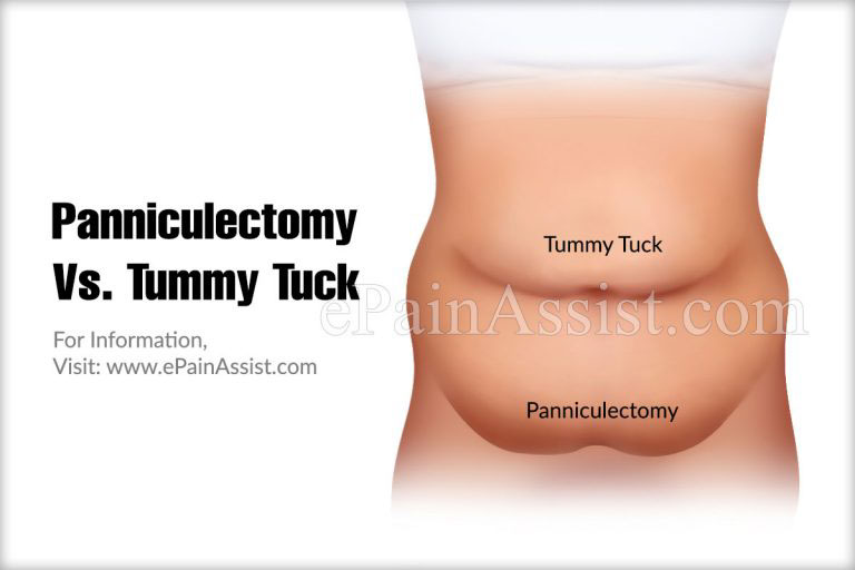 Panniculectomy Vs. Tummy Tuck