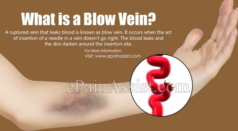 What Causes a Blown Vein & How is it Treated?