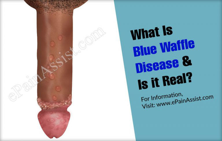 What Is Blue Waffle Disease & Is it Real?