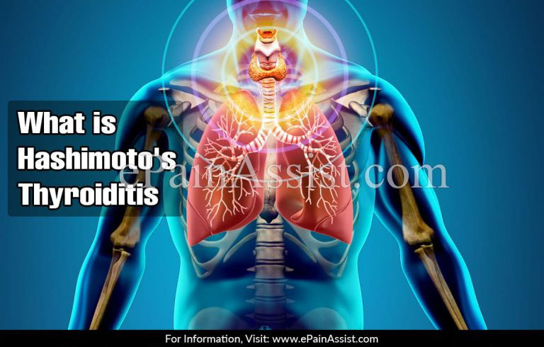 What Causes Hashimoto’s Thyroiditis & Is There A Cure For Hashimoto’s Thyroiditis?