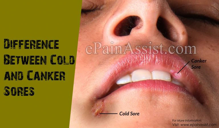Difference Between Cold and Canker Sores and How to Treat Them
