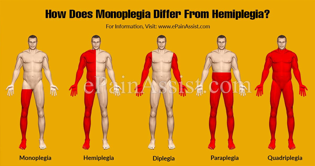 How Does Monoplegia Differ From Hemiplegia?