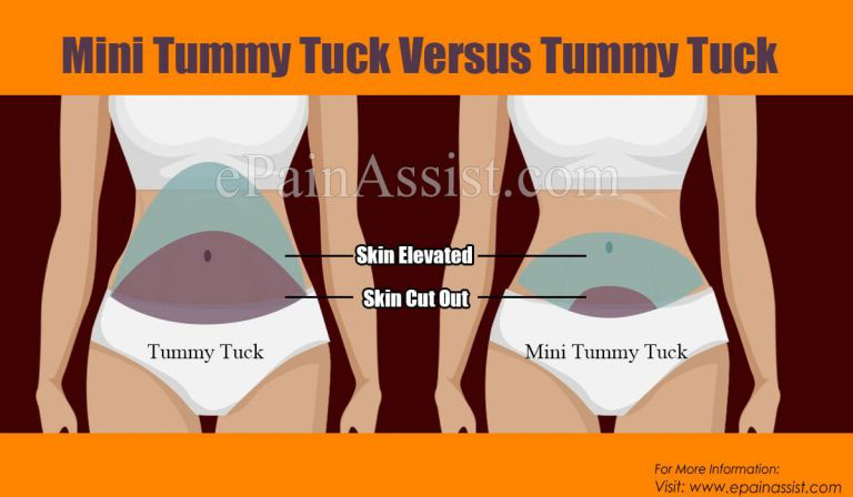 Mini Tummy Tuck Vs Tummy Tuck: Differences Based on Procedure, Risk, Cost, Recovery,  Suitability