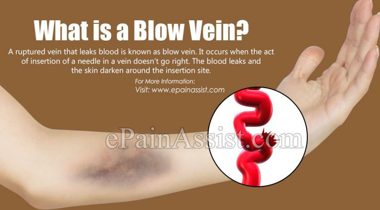 What Causes Blow Vein & How Can It Be Treated?