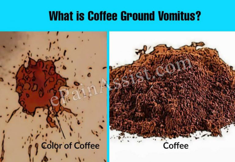 What is Coffee Ground Vomitus & How is it Treated? | Causes, Symptoms, Diagnosis of Coffee Ground Vomitus