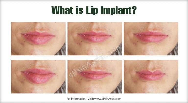 Lip Implant: How is it Performed, Who is a Good Candidate, Safety, Pros & Cons of Lip Implant