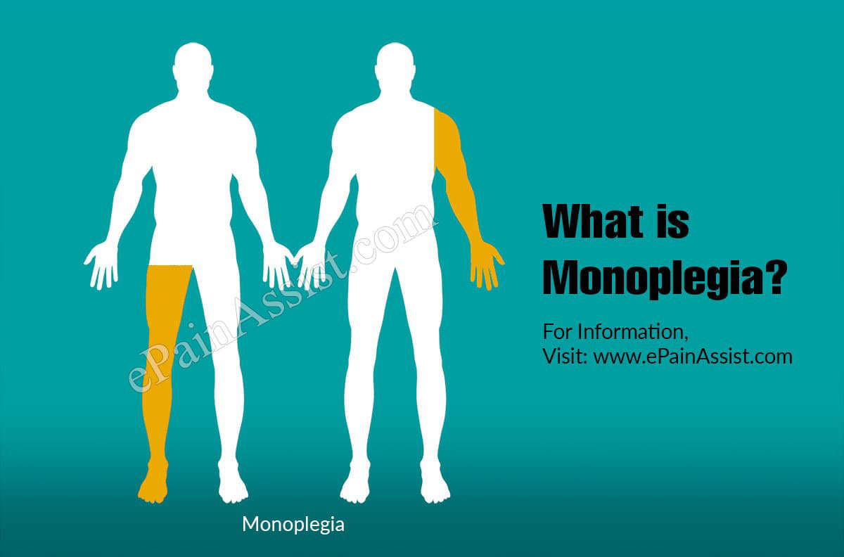 What is Monoplegia?