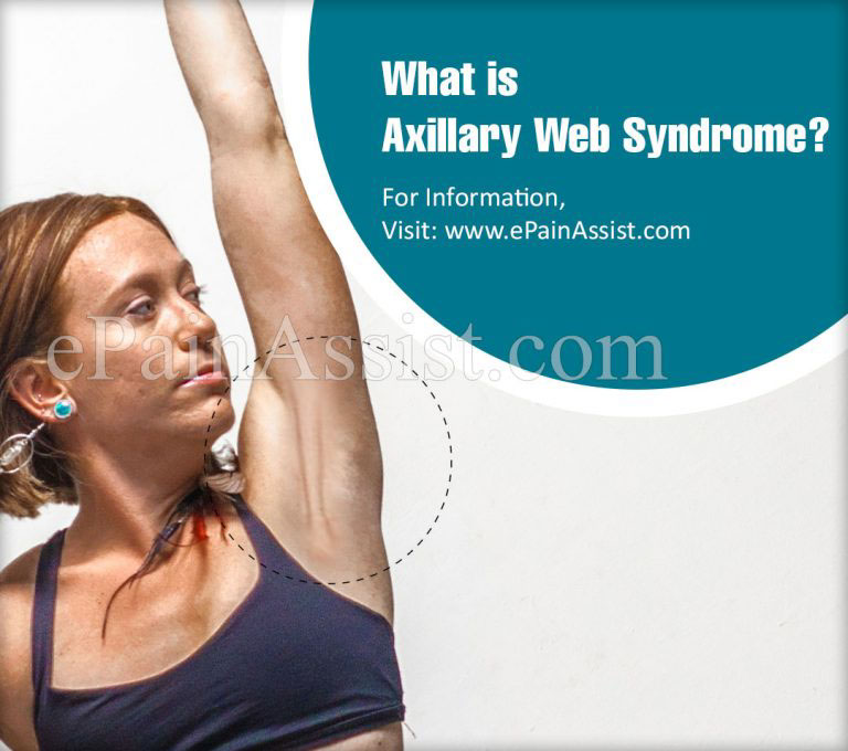What is Axillary Web Syndrome: Causes, Symptoms, Treatment