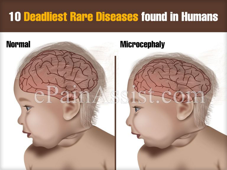 10 Deadliest Rare Diseases found in Humans