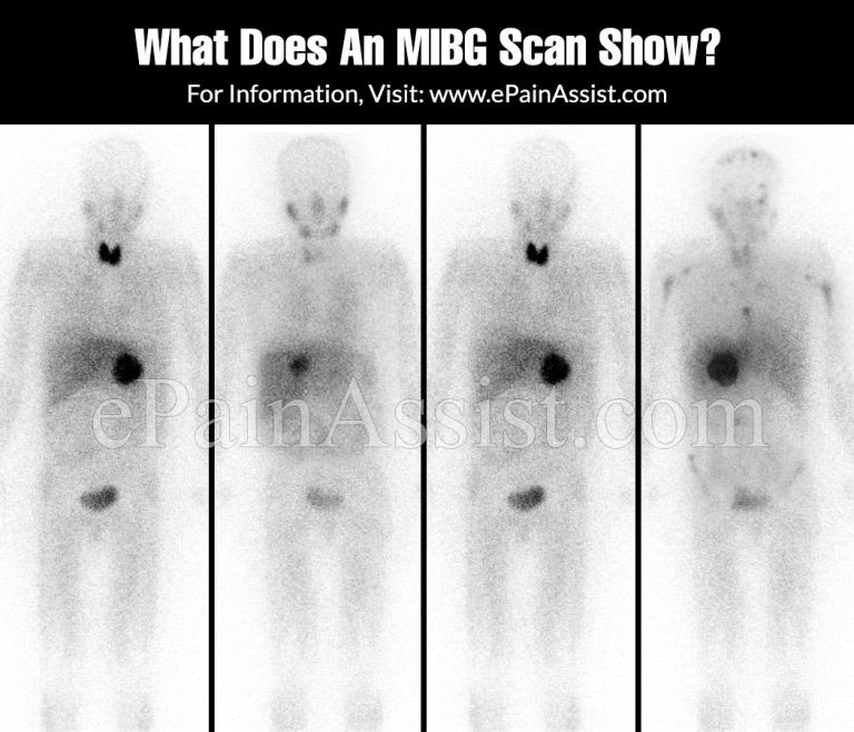What Does An MIBG Scan Show?