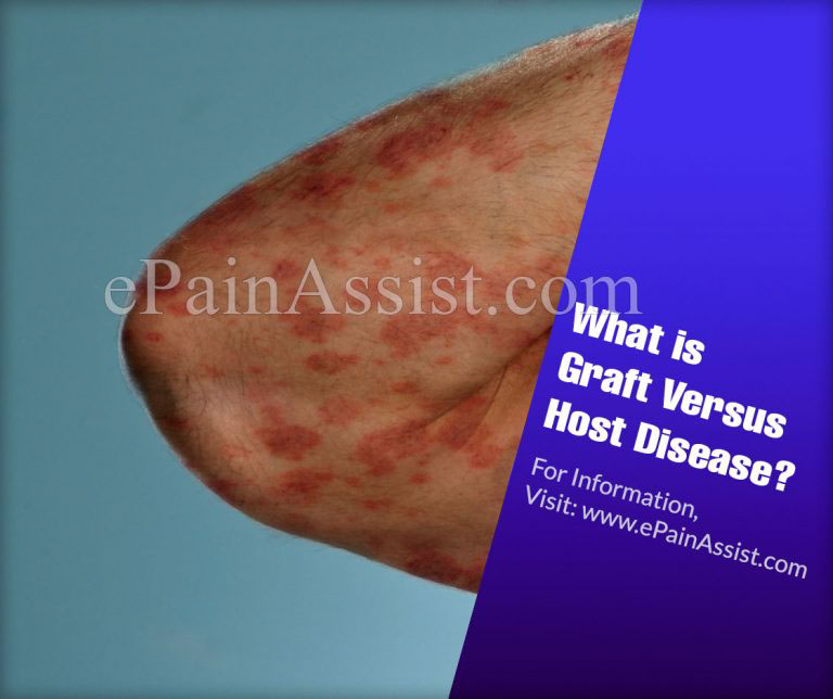 What is Graft Versus Host Disease & How is it Treated? | Causes, Symptoms, Diagnosis of Graft Versus Host Disease