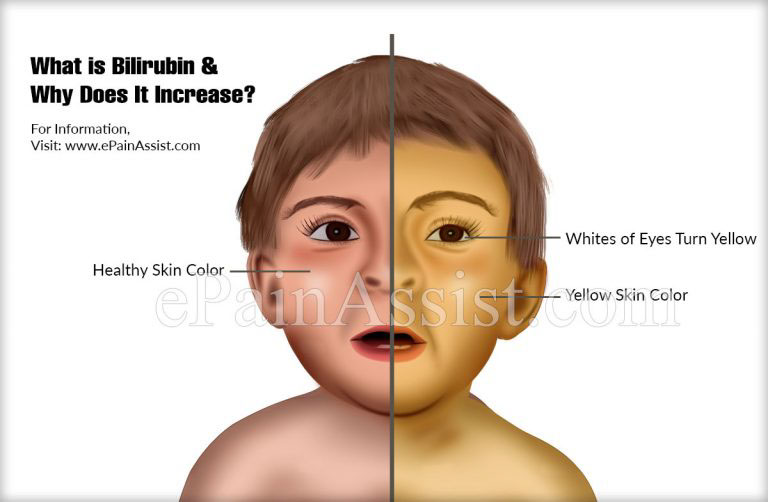 Why Does the Billirubin Increase & How is Jaundice Treated ?