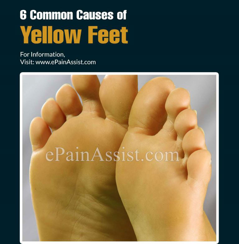 6 Common Causes of Yellow Feet & Its Diagnosis