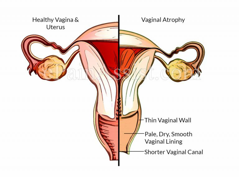 How to Treat Vaginal Dryness for Menopause?