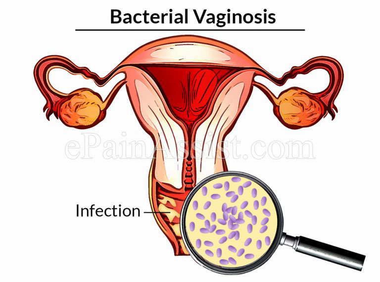 Is Bacterial Vaginosis A Sexually Transmitted Infection & Does That Mean Your Partner Is Cheating On You?