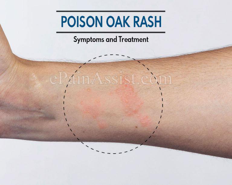 Poison Oak Rash- Symptoms and Treatment