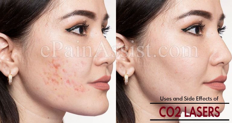 Uses and Side Effects of CO2 Lasers