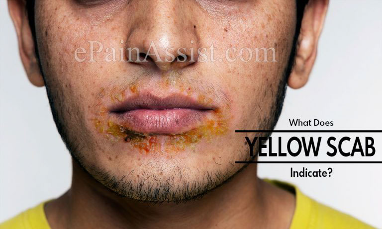 What Does A Yellow Scab Indicate?