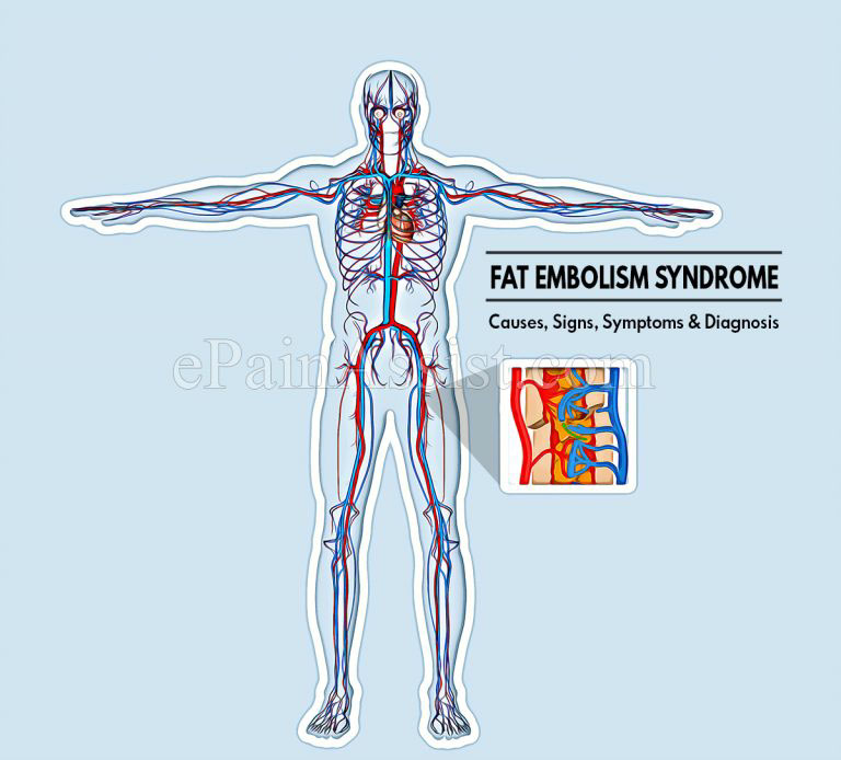 What is Fat Embolism Syndrome & How is it Treated? | Causes, Signs, Symptoms and Diagnosis of Fat Embolism Syndrome