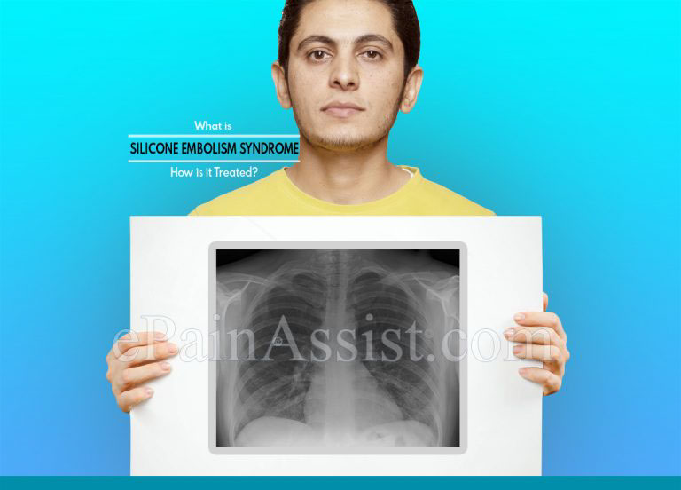 What is Silicone Embolism Syndrome & How is it Treated?|Symptoms and Risk Factors of Silicone Embolism Syndrome