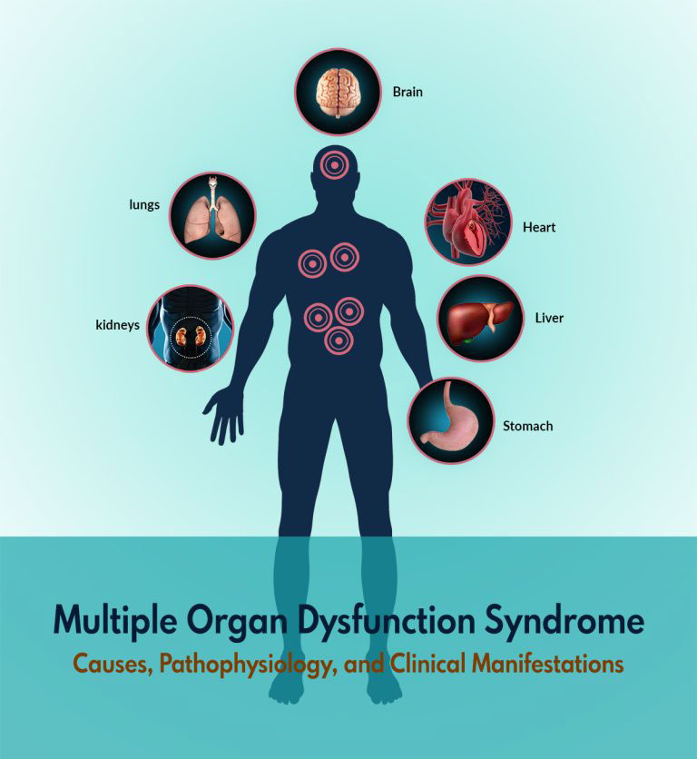 Multiple Organ Dysfunction Syndrome: Causes, Pathophysiology, and Clinical Manifestations