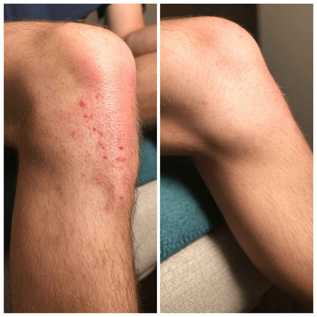Keratosis Pilaris vs Folliculitis vs Bug Bites: Spot the Difference