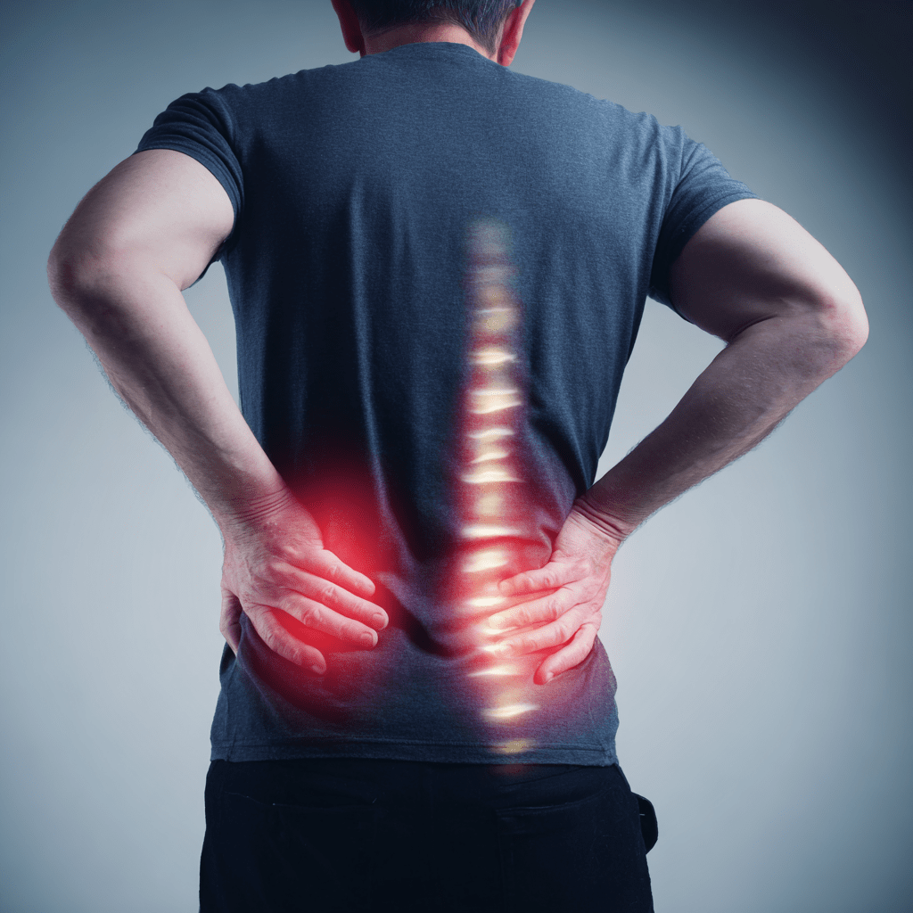 Schmorl’s Nodes Explained: Why They Rarely Cause Back Pain