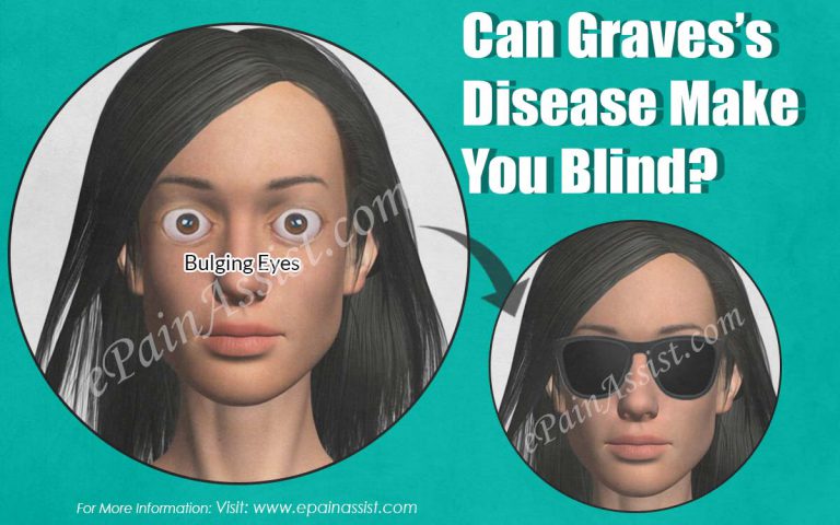 Can Graves’s Disease Make You Blind?