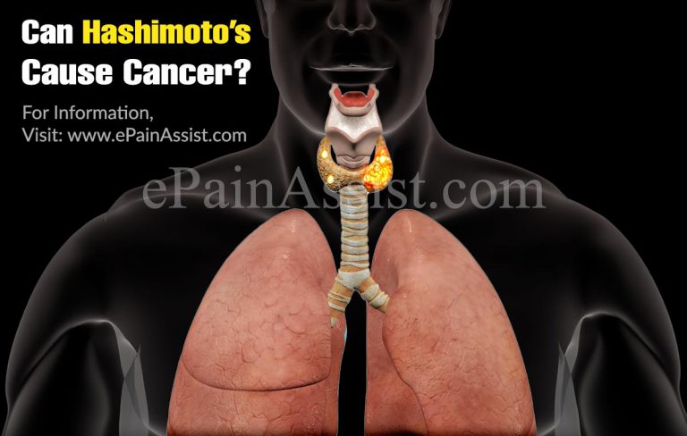 Can Hashimoto’s Cause Cancer?