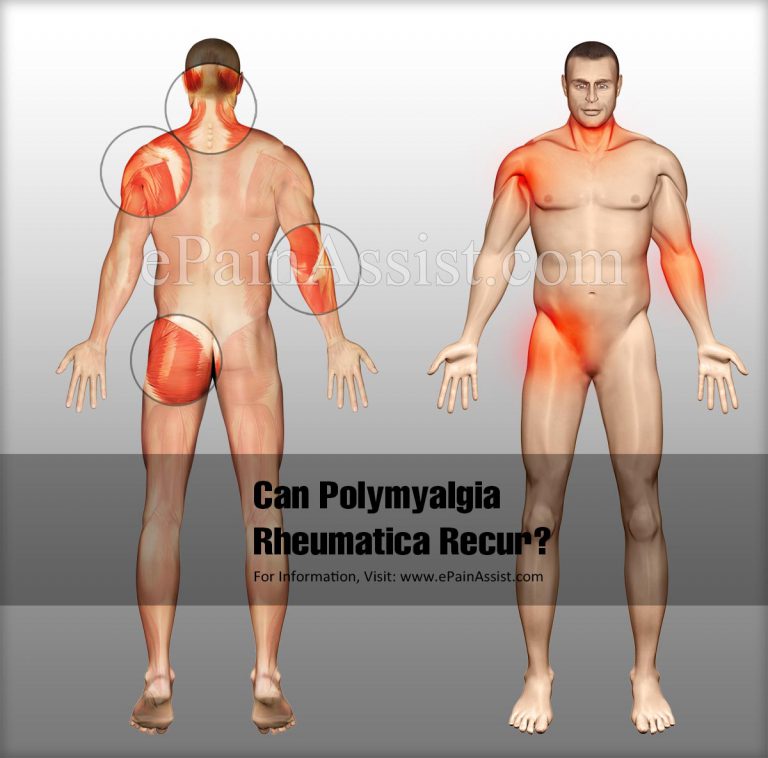 Can Polymyalgia Rheumatica Recur?