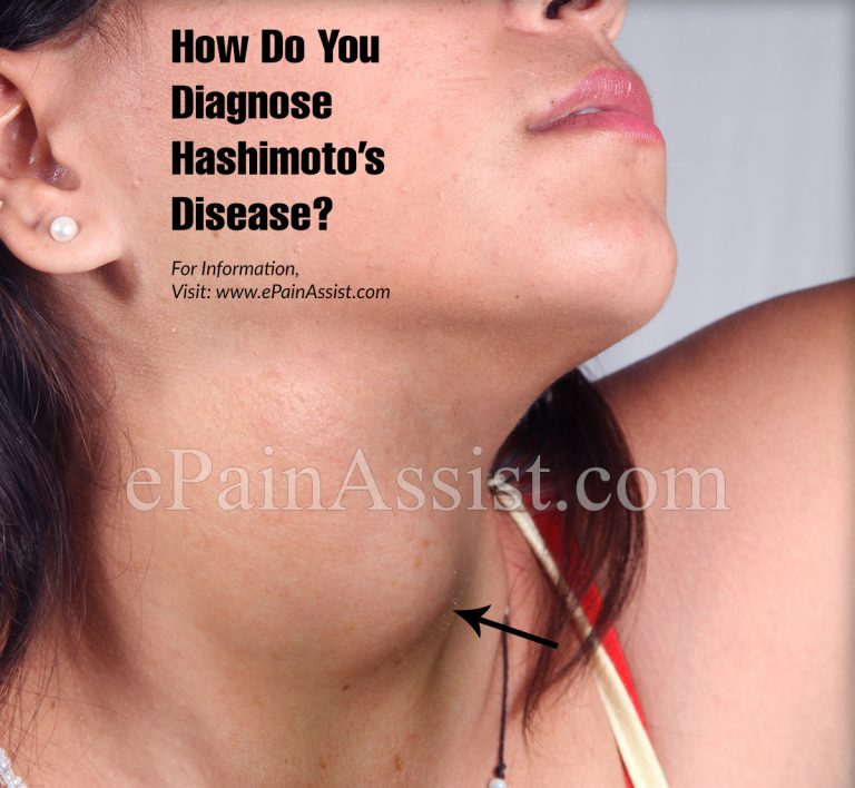 How Do You Diagnose Hashimoto’s Disease?