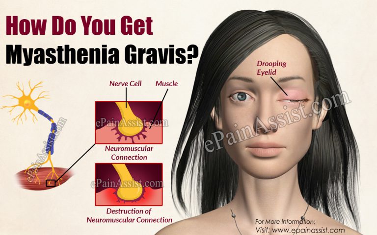 How Do You Get Myasthenia Gravis?