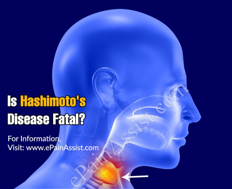Is Hashimoto’s Disease Fatal?