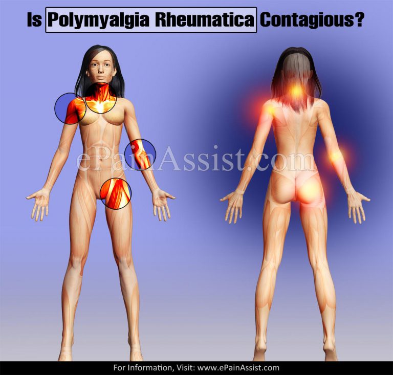 Is Polymyalgia Rheumatica Contagious?