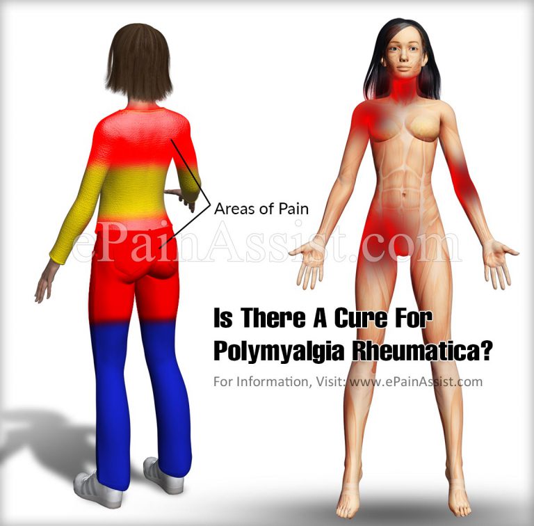 Is There A Cure For Polymyalgia Rheumatica?