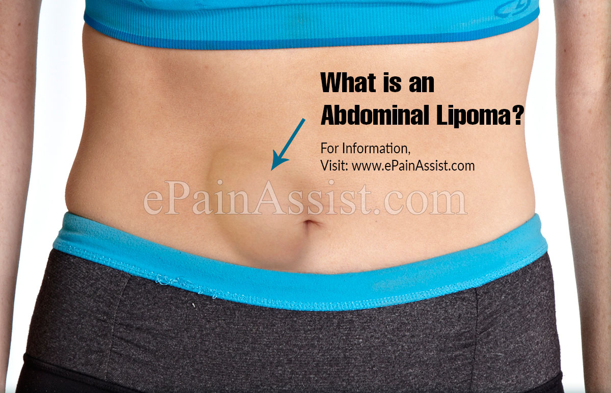 What Is An Abdominal Lipoma?