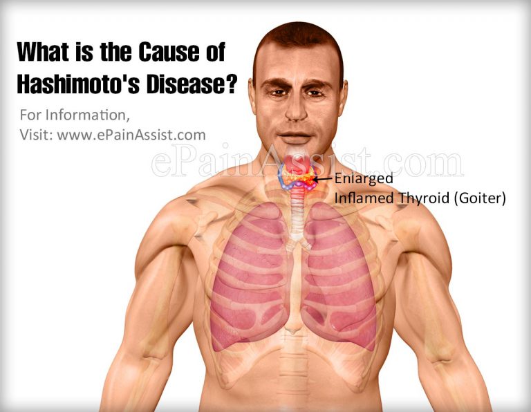 What is the Cause of Hashimoto’s Disease?