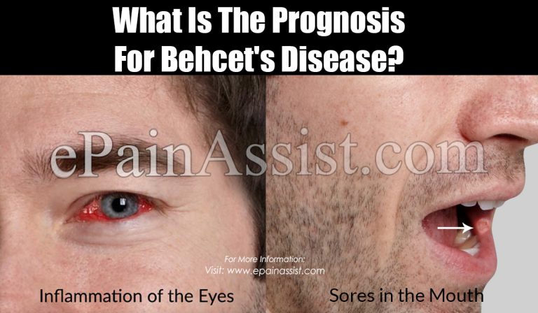 What Is The Prognosis For Behcet’s Disease?