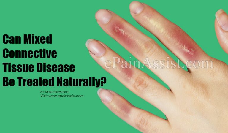 Can Mixed Connective Tissue Disease Be Treated Naturally?