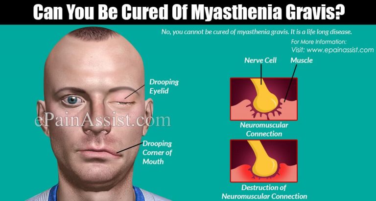 Can You Be Cured Of Myasthenia Gravis?