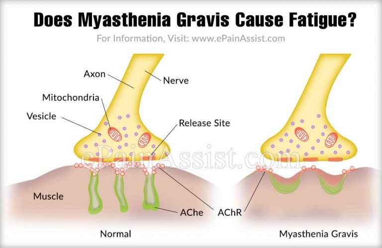 Does Myasthenia Gravis Cause Fatigue?