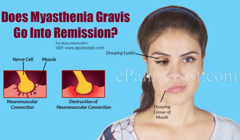 Does Myasthenia Gravis Go Into Remission?