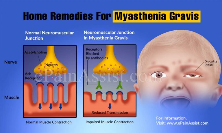 Home Remedies For Myasthenia Gravis
